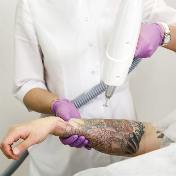 Harmony Laser for Tattoo Removal
